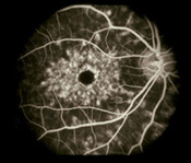 Fundus photograph showing fluorescein angiogram for Stargardt’s disease.