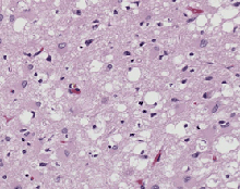 Pink stained brain tissue riddled with white holes.