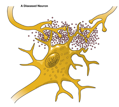 The image of a diseased neuron