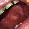 Photo: Red sores (Aphthous)