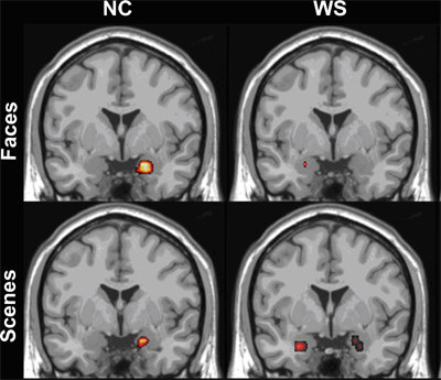 Functional magnetic resonance brain image of people with Williams Syndrome and healthy volunteers