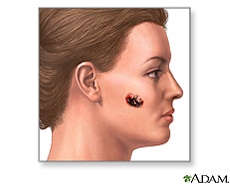 Illustration of a malignant melanoma on the cheek