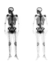 Photograph of bone scans of two people