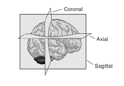 Areas where multiple white–matter tracts cross in different orientations