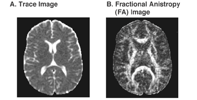 Two types of diffusion tensor imaging