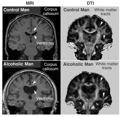 coronal orientation from MRI and DTI studies