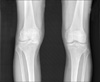Osteoarthritic Knees