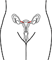 A drawing of the transcervical surgical sterilization implant, which blocks the fallopian tubes.