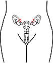 A drawing of a trans-abdominal surgical sterilization, where a device is placed outside of each fallopian tube.