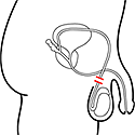 A drawing of a vasectomy - where the mas's vas deferens is blocked.