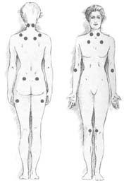 The location of the nine paired tender points that comprise the 1990 American College of Phrumatology criteria for fibromyalgia