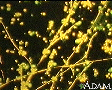 Photograph of a microscopic film showing a fluorescent stain of Candida, a yeast (fungus)