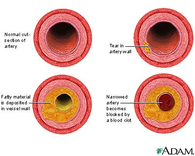 An illustration of how a blood clot forms; courtesy of Medline Plus Medical Encyclopedia