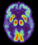Estudio TEP* de un cerebro con Alzheimer