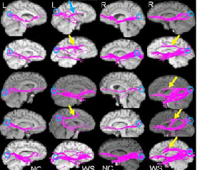 Faulty wiring in Williams Syndrome