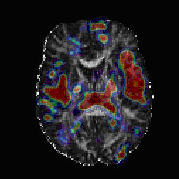 Fiber tract differences in schizophrenia