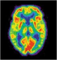 PET Scan of Normal Brain