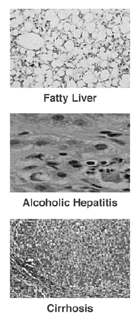 Alcoholic Liver Disease