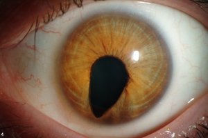 Uveal coloboma affecting the iris - source: NEI; Dr. Brian Brooks