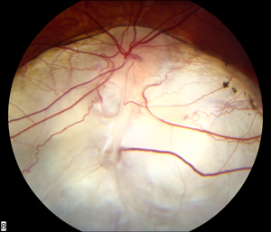 Uveal coloboma