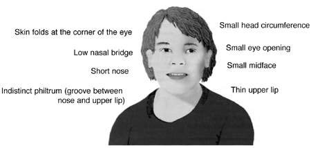 Craniofacial features associated with fetal alcohol syndrome