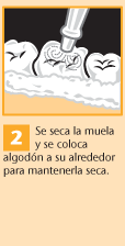 2.  Se seca la muela y se coloca algodón a su alrededor para mantenerla seca.