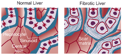 Pericentral fibrosis in alcoholic liver disease