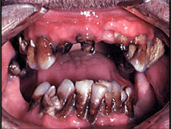 Photo of a Meth Mouth