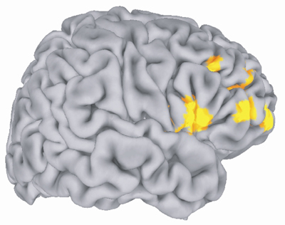 PET image highlighting areas of the prefrontal cortex whose blood flow reacts to midbrain dopamine synthesis, which is linked to the COMT gene.