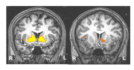 Adolescent Brains Show Reduced Reward Anticipation