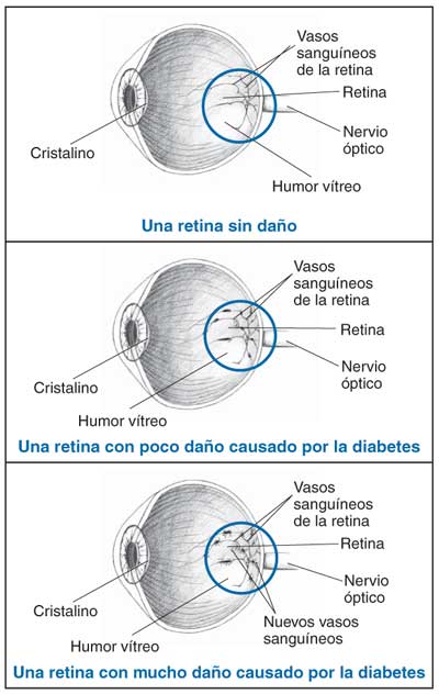 Un cuadro mostrando las tres diferentes etapas del daño a la retina causado por la diabetes, el primer cuadro enseña a el ojo con una retina sin daño, el segundo cuadro ensena a el ojo con una retina con poco daño, y el tercer cuadro enseña el ojo con una retina con bastante daño.