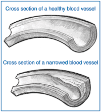 Drawing of two blood vessels.  The blood vessels are drawn in cross-section to reveal the inside wall of the vessels.  The healthy blood vessel has a smooth inner wall.  The other blood vessel shows build-up of fatty material, which narrows the blood vessel.