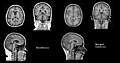 Comparison of two female subjects who had volumetric MRIs created in a GE 1.5 Tesla MRI machine