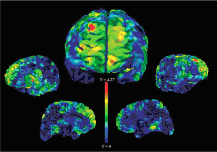 Childhood bedwetting linked to reduced gray matter in the front of the brain (red areas).