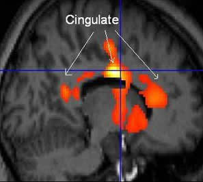 Image of PET/MRI Cingulate Cortex