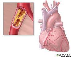 Illustration of the heart featuring coronary artery blockage (atherosclerosis)