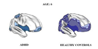 Brain matures late in ADHD