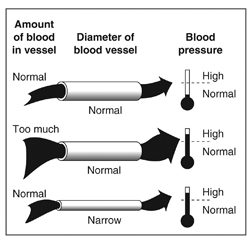 Diagram of three blood vessels. Labels at the top of the diagram read “Amount of blood in vessel,” “Diameter of blood vessel,” and “Blood pressure.” In each drawing, blood is represented as an arrow traveling through a tubelike vessel. The top drawing shows a normal amount of blood in a vessel of normal diameter, resulting in normal blood pressure. The middle drawing shows too much blood in a vessel of normal diameter, resulting in high blood pressure. The bottom drawing shows a normal amount of blood flowing through a narrow blood vessel, resulting in high blood pressure. To the right of each blood vessel is a gauge that looks like a thermometer. The gauge to the right of the top drawing is shaded only in the lower part, indicating normal blood pressure. The gauges to the right of the middle and bottom drawings are shaded nearly to the top, indicating high blood pressure.