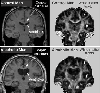 Images comparing a healthy control man with an alcoholic man