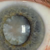 A hypermature age-related cortico-nuclear cataract with a brunescent (brown) nucleus.