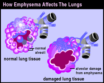 picture of lung damaged by emphysema
