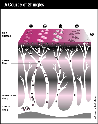 graphic shows the path the virus travels up nerve fibers to cause shingles and the appearance of the blisters