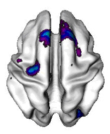 ADHD child brain with areas of thin cortex