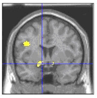 Overactivation of the Amygdala