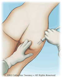 Illustration of liposuction on buttocks area