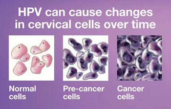 HPV can cause changes in cervical cells over time. Image shows normal cells, pre-cancer cells, and cancer cells.