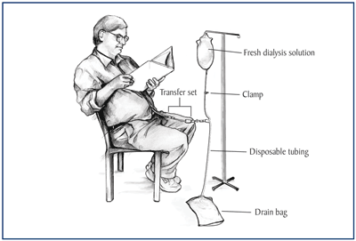 Drawing of a male patient sitting in chair, performing peritoneal dialysis exchange.  Labels indicate fresh bag of dialysis solution, clamp, transfer set, disposable tubing, and drain bag.