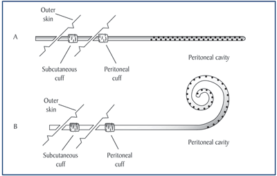 Illustration of two peritoneal catheters.