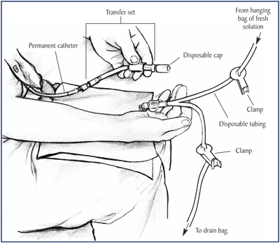Close-up drawing of patient holding his catheter and transfer set in his left hand and a Y-tube in his right.  Only the patient’s lap and hands are visible.  Labels indicate the catheter, transfer set, disposable cap, clamps, a tube running from the fresh bag of solution, and a tube running to the drain bag.