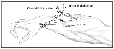 Ilustración de un brazo con agujas arteriales y venosas.